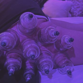 Cry Baby Massage - Cupping to the leg - Massage Therapy Near Me - Fresno, California Cry Baby Massage - Cupping to the leg - Massage Therapy Near Me - Fresno, California