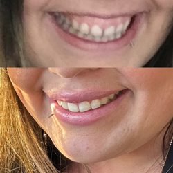 Skin & Beauty Bar - Before and after - I did lip filler and gummy smile treatment