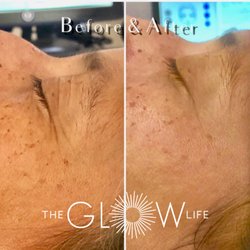 The Glow Life - Before & After HydraFacial with connective tissue growth factor booster.