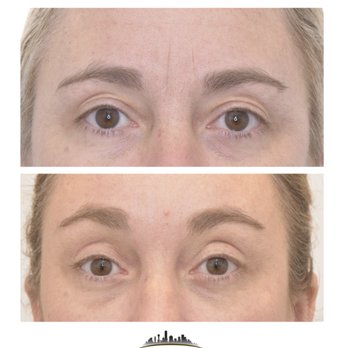 Dallas Surgical Arts: Randy R. Sanovich, DDS - Browlift at Dallas Surgical Arts - Cosmetic Surgeons Near Me - Dallas, Texas Dallas Surgical Arts: Randy R. Sanovich, DDS - Browlift at Dallas Surgical Arts - Cosmetic Surgeons Near Me - Dallas, Texas
