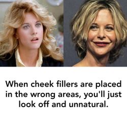 Cynthia Lopez, MD - Beware of puffy cheeks. We follow the golden ratio to create perfect, sensational looking cheeks.