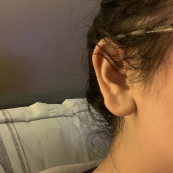 Dev Wali, MD Plastic Surgery-Medspa - Before - right ear - Cosmetic Surgeons Near Me - Claremont, California