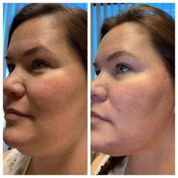 Quinn Aesthetics - Full face PDO I didn't look 10lbs I just had threads those are immediately after the threads - Skin Care Near Me - Riverside, California