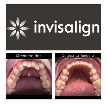 Jessica Tendero, DDS - Invisalign - Before & After - Cosmetic Dentists Near Me - Miami, Florida Jessica Tendero, DDS - Invisalign - Before & After - Cosmetic Dentists Near Me - Miami, Florida