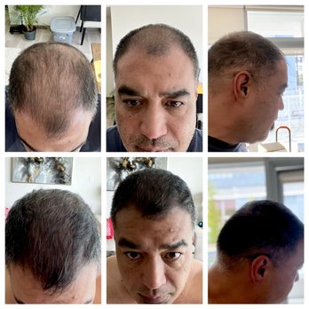 Gateway Acupuncture & Alchemy - Hair re-growth using scalp derma puncturing. This is my 3-4 month before and after result. - Acupuncture Near Me - San Diego, California Gateway Acupuncture & Alchemy - Hair re-growth using scalp derma puncturing. This is my 3-4 month before and after result. - Acupuncture Near Me - San Diego, California