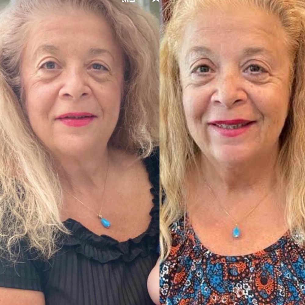 Jeffrey Paul Edelstein, MD - On the left before surgery on the right after surgery - Ophthalmologists Near Me - Chandler, Arizona Jeffrey Paul Edelstein, MD - On the left before surgery on the right after surgery - Ophthalmologists Near Me - Chandler, Arizona