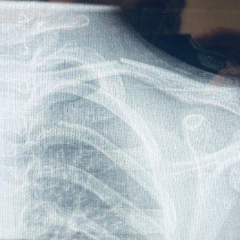 HeCares - Remington Office - Fractured Collarbone - Acupuncture Near Me - Sunnyvale, California HeCares - Remington Office - Fractured Collarbone - Acupuncture Near Me - Sunnyvale, California