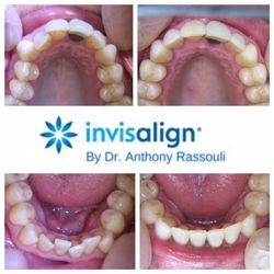 Center for Oral Health - Let your smile do the talking after Invisalign and Dr. A. do their magic. Call us today for your complimentary consultation: (714) 842-5561