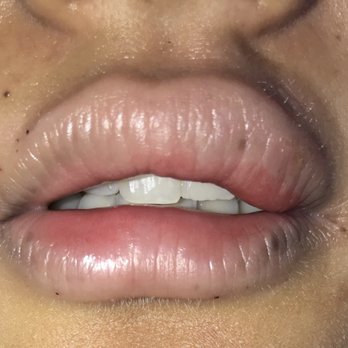 Lucent Cosmetics - Right after procedure - Medical Spas Near Me - Glendora, California