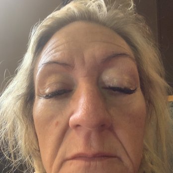 RediscoverdU - Lines on sides of nose, cheeks and thin lips. BEFORE - Skin Care Near Me - Bainbridge Island, Washington RediscoverdU - Lines on sides of nose, cheeks and thin lips. BEFORE - Skin Care Near Me - Bainbridge Island, Washington