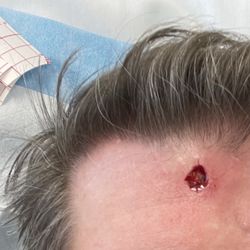 California Dermatology and Mohs Surgery Specialists - Immediately after Moh's surgery.