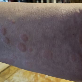 Gold Richard MD - Yet another photo of my legs covered in hives at his advice to eat the foods rather than test me first! - Doctors Near Me - Smithtown, New York Gold Richard MD - Yet another photo of my legs covered in hives at his advice to eat the foods rather than test me first! - Doctors Near Me - Smithtown, New York