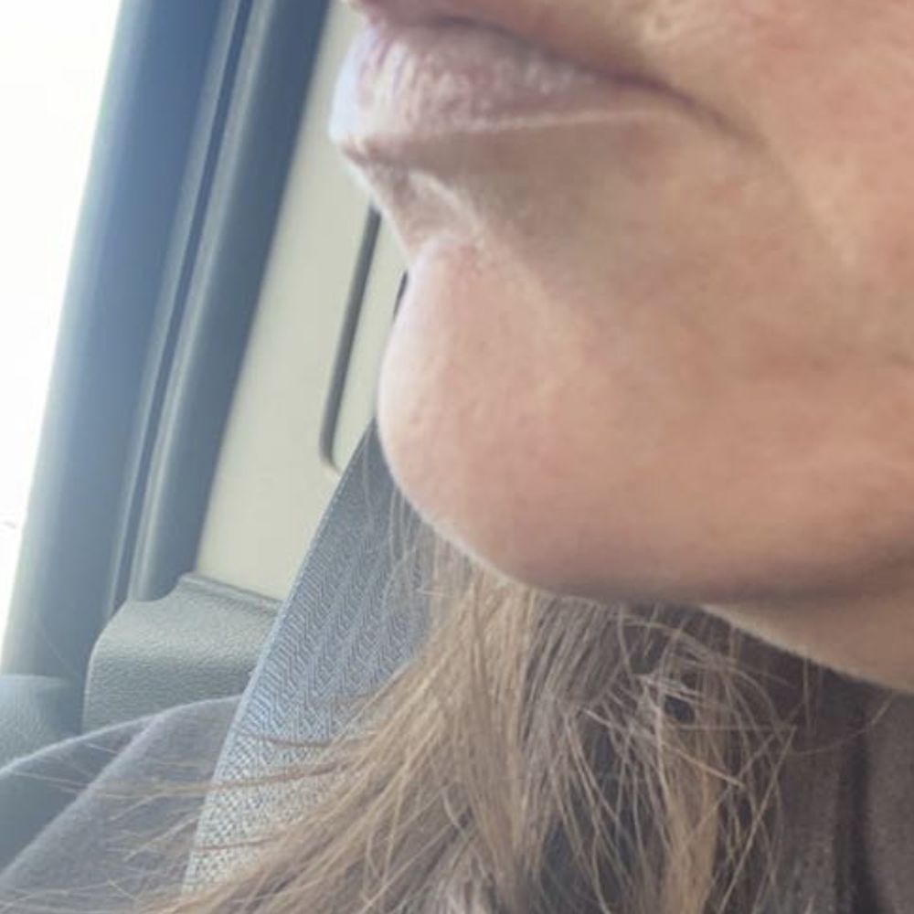 Halo Med Spa - Right after lip fillers - Skin Care Near Me - Albuquerque, New Mexico