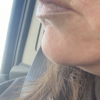 Halo Med Spa - Right after lip fillers - Skin Care Near Me - Albuquerque, New Mexico Halo Med Spa - Right after lip fillers - Skin Care Near Me - Albuquerque, New Mexico