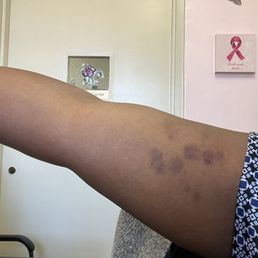 Bruises from massage.