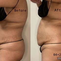 Roxanne Body Sculpting - First session of Enhanced Brazilian Slimming Massage.