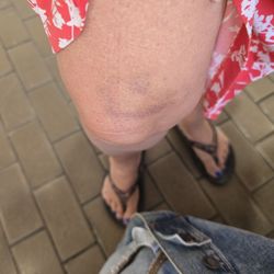 East County Regional Center - Courthouse - Bruises from the encounter with the brute