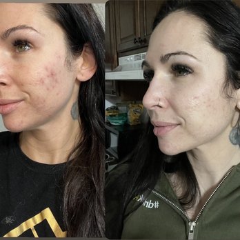 Skin By Beth Ann Warren - I still have a bit of pick scaring but it's improved so much - Skin Care Near Me - Lake Oswego, Oregon Skin By Beth Ann Warren - I still have a bit of pick scaring but it's improved so much - Skin Care Near Me - Lake Oswego, Oregon