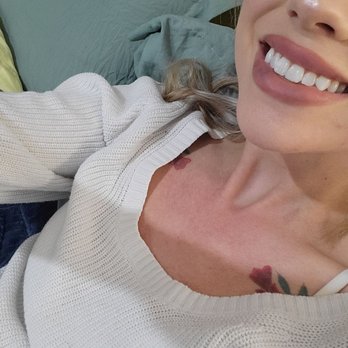 Gallery Plastic Surgery - Nurse Alicia did an amazing job on my first lip Injections. I was very nervous at first but it was completely painless. - Cosmetic Surgeons Near Me - Monterey, California
