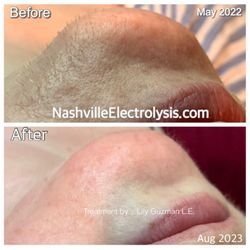 Course hair can make the skin look textured & uneven. Removal of these hairs will make the skin look smooth & flawless.