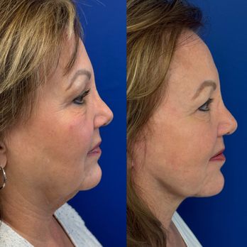 Samir S Undavia, MD - Deep Plane Facelift, Liposuction & Platysmaplasty - Cosmetic Surgeons Near Me - Marlton, New Jersey Samir S Undavia, MD - Deep Plane Facelift, Liposuction & Platysmaplasty - Cosmetic Surgeons Near Me - Marlton, New Jersey