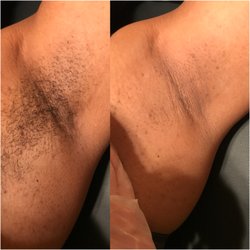 Before and after underarm