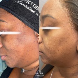 ClubHouse Skin and Laser Medspa - EVEN GLOW PEEL SERIES