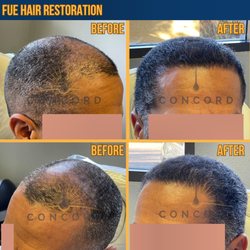 Concord Hair Restoration - 3000 graft FUE procedure