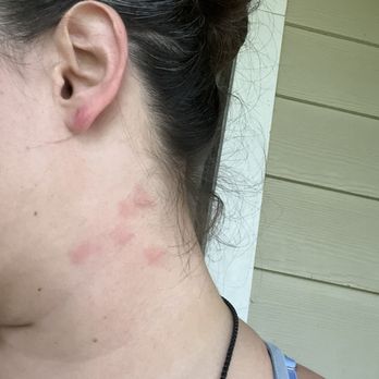 Ocean Creek Resort - Bites on my face neck and ear - Resorts Near Me - Myrtle Beach, South Carolina Ocean Creek Resort - Bites on my face neck and ear - Resorts Near Me - Myrtle Beach, South Carolina