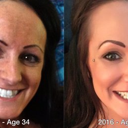 Ashley Wiese at Laser & Wellness Center has taken years off my face! Ashley Wiese at Laser & Wellness Center has taken years off my face!