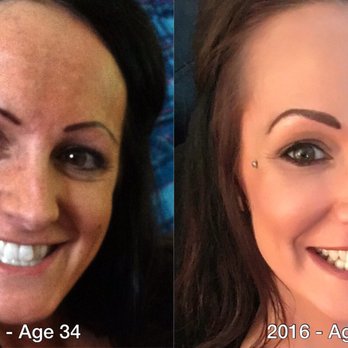 Laser & Wellness Center - Ashley Wiese at Laser & Wellness Center has taken years off my face! - Laser Hair Removal Near Me - Vancouver, Washington Laser & Wellness Center - Ashley Wiese at Laser & Wellness Center has taken years off my face! - Laser Hair Removal Near Me - Vancouver, Washington