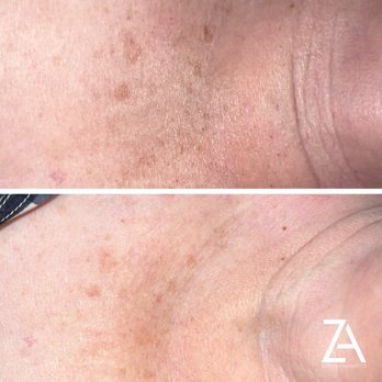 Zaretsky Aesthetics - IPL - Medical Spas Near Me Zaretsky Aesthetics - IPL - Medical Spas Near Me