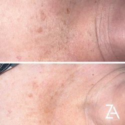 Zaretsky Aesthetics - IPL