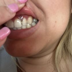 Accu Dental & Orthodontics - Left upper and lower teeth deep Cleaning on 05/23/24 @4pm. Today 05/24/24 yellow pus infection @3pm.