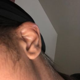 burned ear burned ear