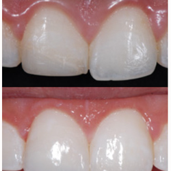Durham Dental Group - Before and After - Bonding and Filling