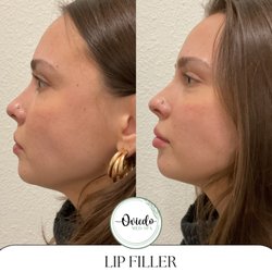 Oviedo Med Spa - Lip Filler