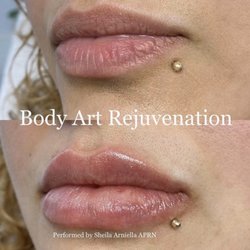 Body Art Rejuvenation - Lip filler injections.