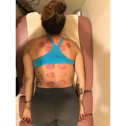Cupping for myofascial relief, immediately following removal of cups.