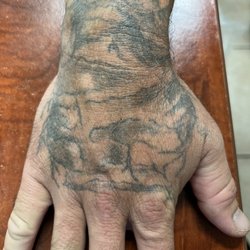Way Gone Laser Tattoo Removal - Tattoo