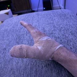 Jeffrey Yao MD - Thumb surgery