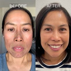 Radiant Beauty Skin Care Med Spa - AEROLASE laser skin rejuvenation + Pixel8-RF microneedling + chemical peel