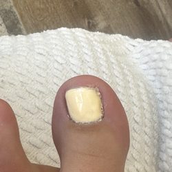 Gel on toes