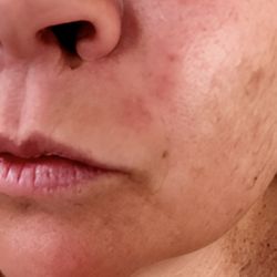 The Palm Beach Center for Facial Plastic & Laser Surgery - before