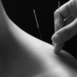 A Hip Joint - Downtown - Acupuncture
