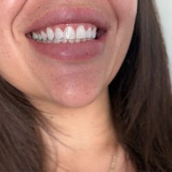 West Hollywood Smile Dental - Teeth