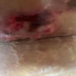 Surgeon lipo burn Surgeon lipo burn