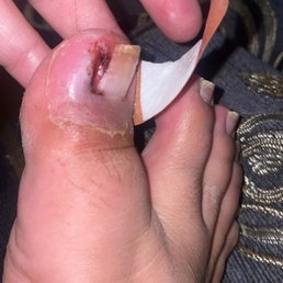The day after he took my ingrown toe nail The day after he took my ingrown toe nail