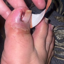 Pomona Valley Podiatry Group, Inc. Pomona Foot Doctor - The day after he took my ingrown toe nail