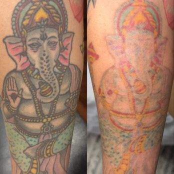 Allure laser Tattoo Removal - After 3 sessions, removed black ink only - Medical Spas Near Me - Dallas, Texas Allure laser Tattoo Removal - After 3 sessions, removed black ink only - Medical Spas Near Me - Dallas, Texas